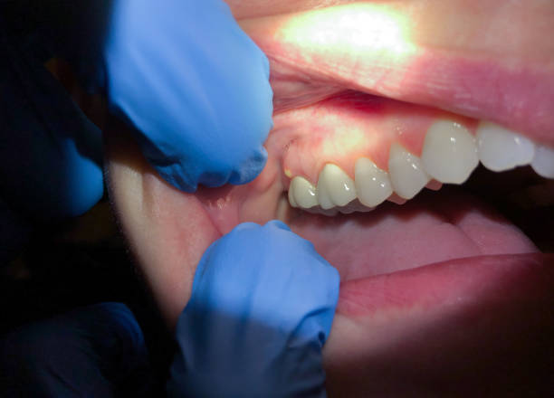 Best Emergency Root Canal Treatment in Shavertown, PA